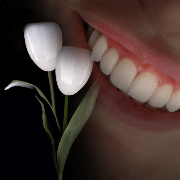 لمینت دندان چیست؟