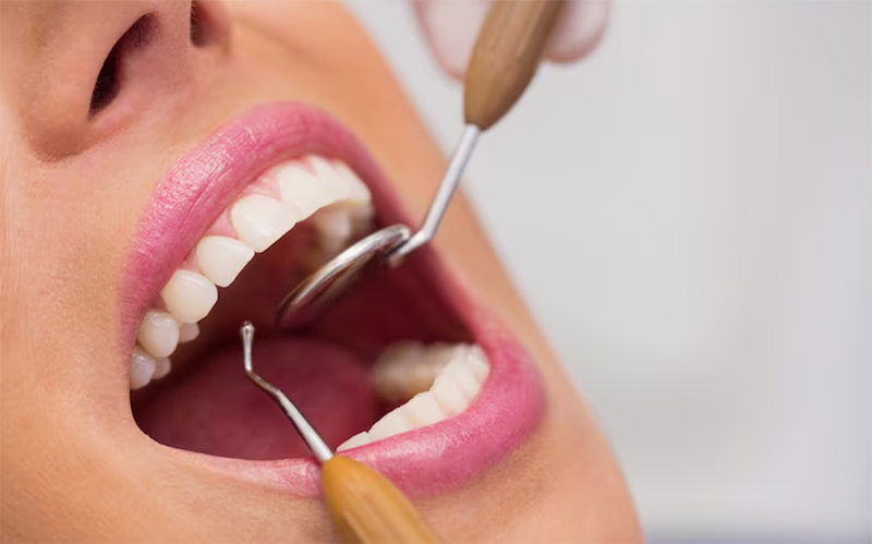 آیا میتوان دندان عصب کشی شده را لمینت کرد؟