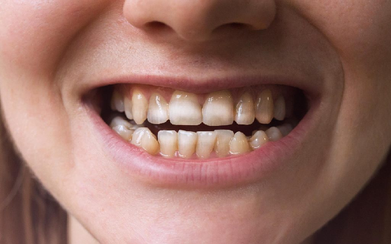 بلچینگ دندان چگونه انجام می گیرد؟