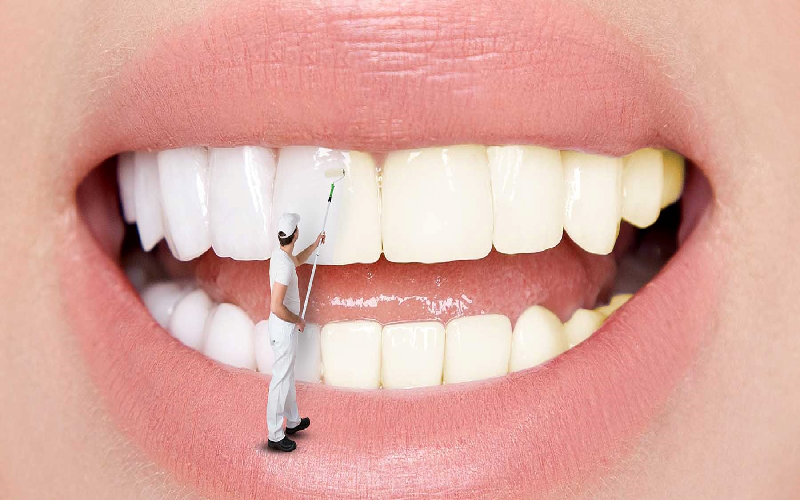 مزایای بلچینگ دندان