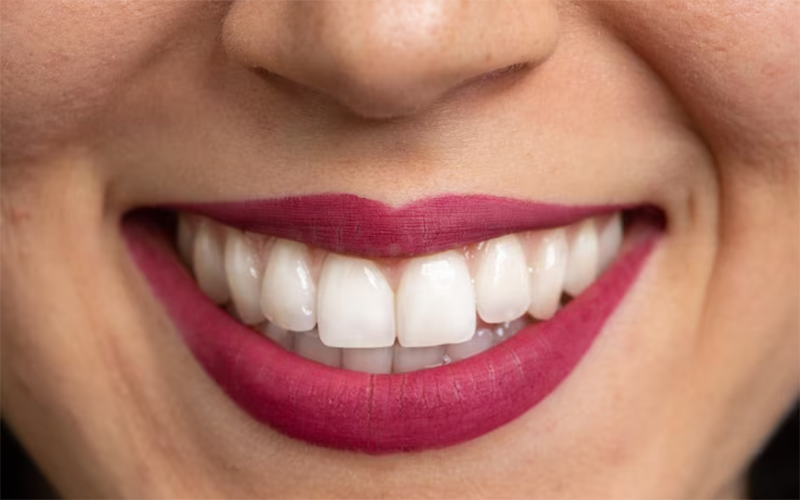 لمینت می‌تواند جایگزین روکش در دندان های عصب کشی شده باشد؟
