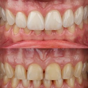 مزایا و معایب استفاده از لمینت برای دندان ‌های شکسته
