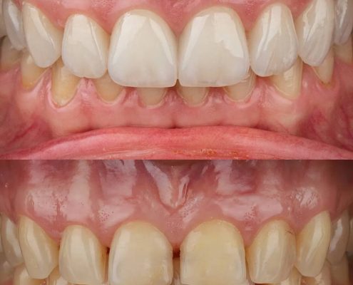 مزایا و معایب استفاده از لمینت برای دندان ‌های شکسته