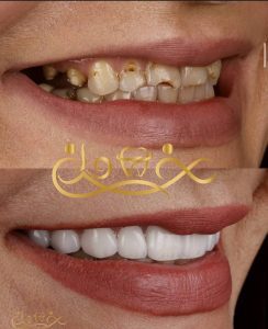 لمینت دندان شکسته چیست؟