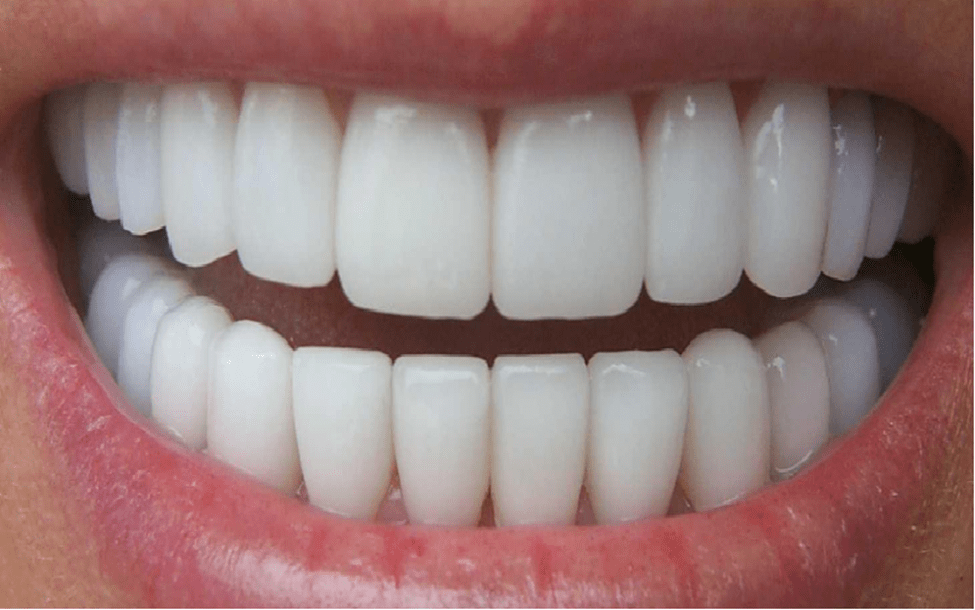 آیا می‌ توان دندان روکش شده را کامپوزیت کرد؟