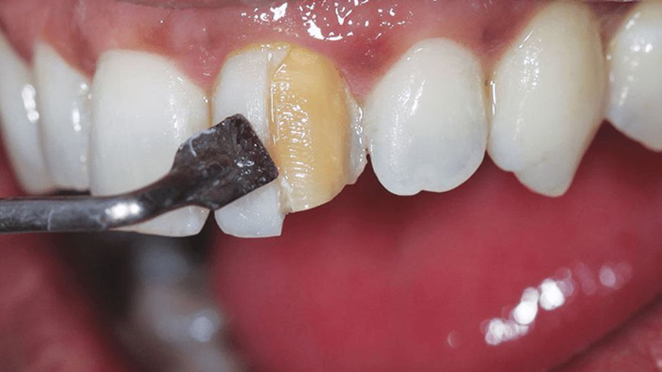 مقایسه مراحل آماده سازی دندان در کامپوزیت و روکش