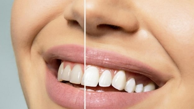تفاوت روکش دندان با کامپوزیت چیست؟