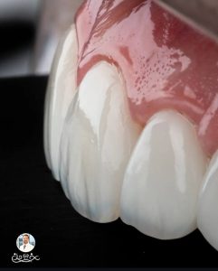 شیوه درمانی کامپوزیت دندان مناسب چه افرادی است؟