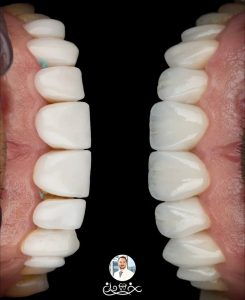 برای گرفتن نوبت از بهترین دکتر لمینت دندان در زعفرانیه تهران چه کنیم؟