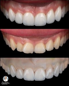لبخندی درخشان با لمینت دندان در شمال تهران 😁 | بهترین متخصصین در منطقه ۱ تهران
