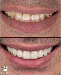 چگونه لمینت دندان میتواند اعتماد به نفس شما را افزایش دهد؟