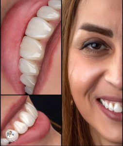 لمینت دندان شمال تهران