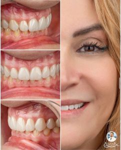 ظاهر طبیعیتر لمینت سرامیکی