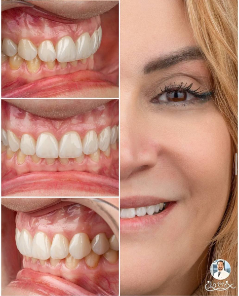 ظاهر طبیعیتر لمینت سرامیکی