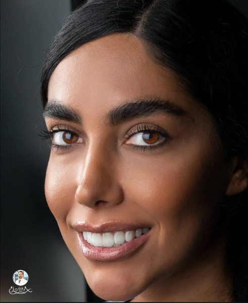 مراحل کامپوزیت دندان