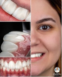 کامپوزیت دندان چیست؟