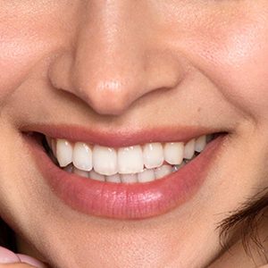 بلیچینگ دندان در زعفرانیه؛ راهنمای تخصصی برای لبخندی درخشان