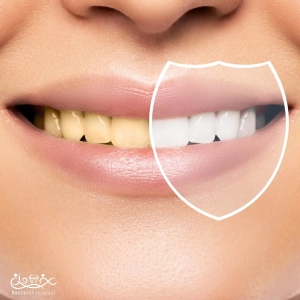 بلیچینگ دندان در شمال تهران — راز لبخندهای درخشان و ماندگار