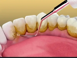 جرمگیری دندان در شمال تهران؛ لبخند واقعیتان را همین امروز برگردانید ✨ | رزرو نوبت فوری