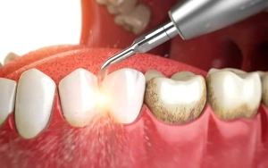 جرمگیری دندان در ولنجک — چه زمانی، چگونه و چرا بیماران خاص منطقه ۱ به کلینیک من مراجعه میکنند؟